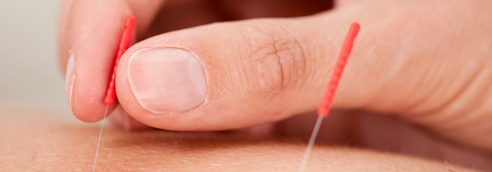 Acupuncture Acupuncture