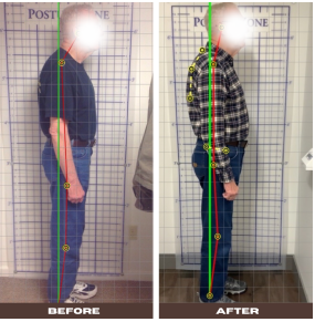 Chiropractic Dardenne Prairie MO Before and After 1 Chiropractic Dardenne Prairie MO Before and After 1