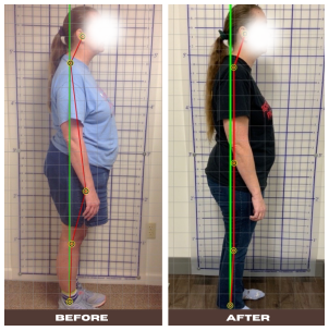 Chiropractic Dardenne Prairie MO Before and After 3 Chiropractic Dardenne Prairie MO Before and After 3